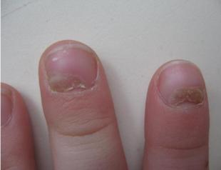 Ногти как «индикатор» Вашего здоровья Ямки на больших пальцах рук